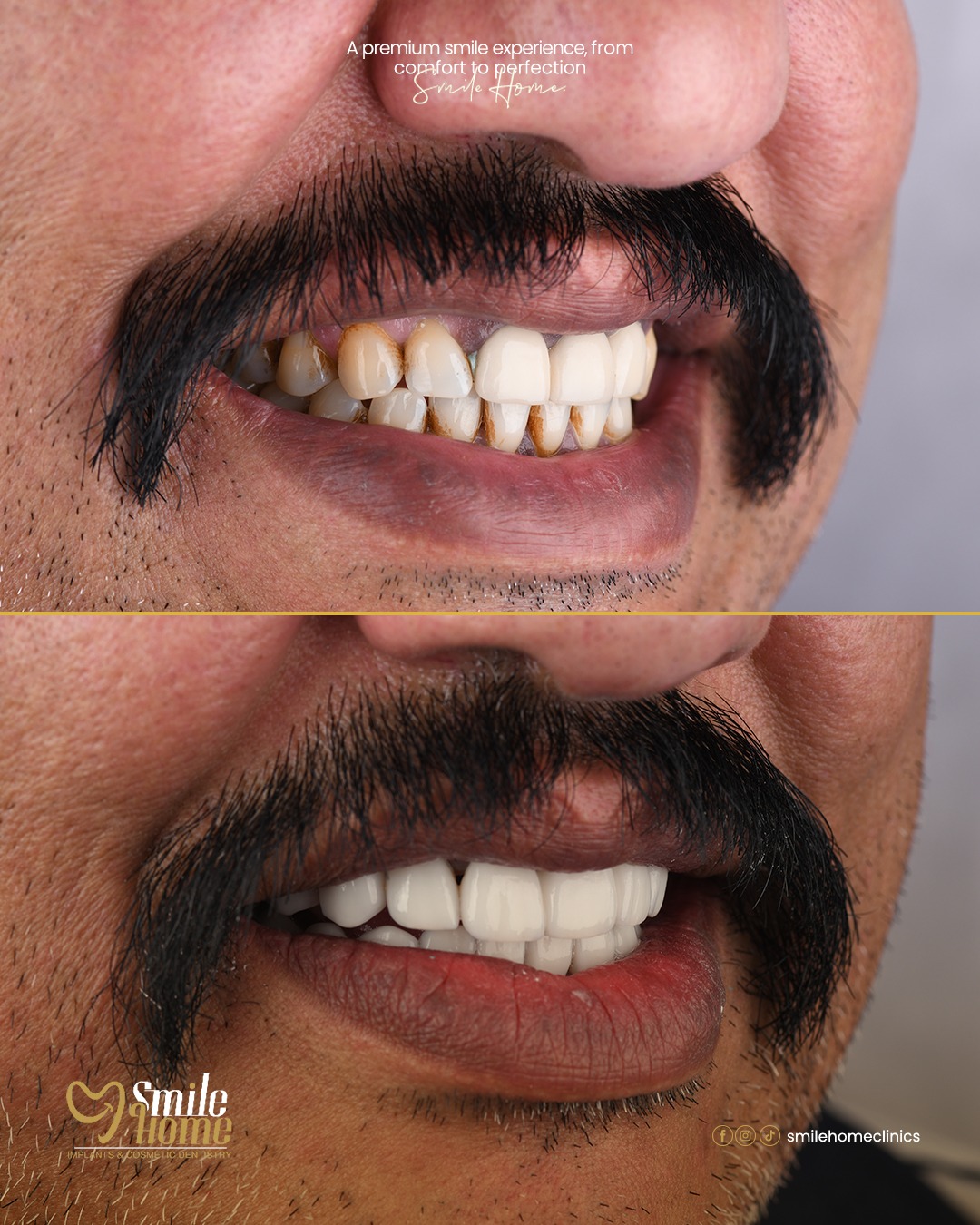 Fixed prosthesis
