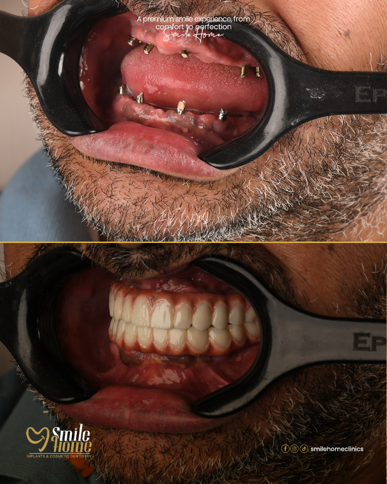 Implants