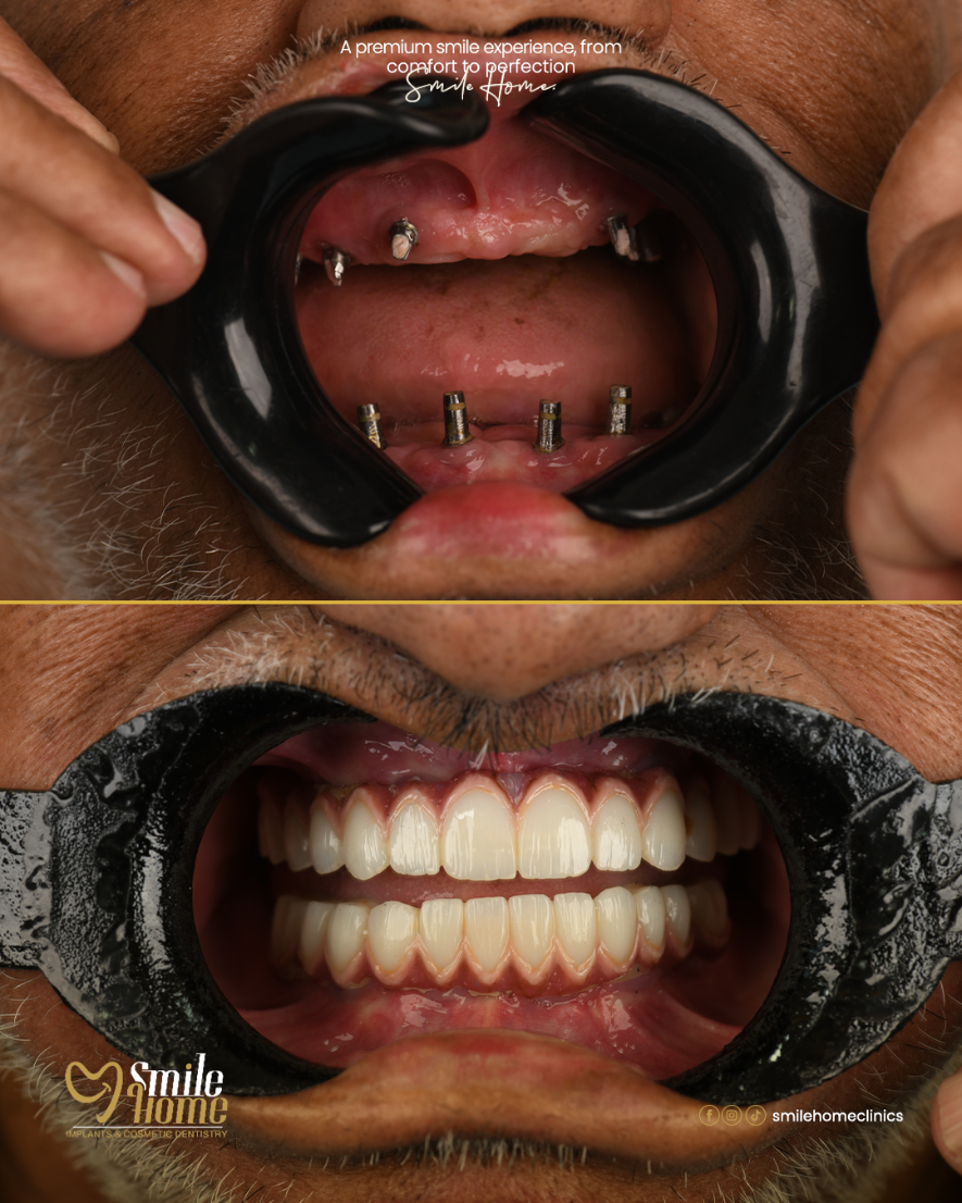 Implants