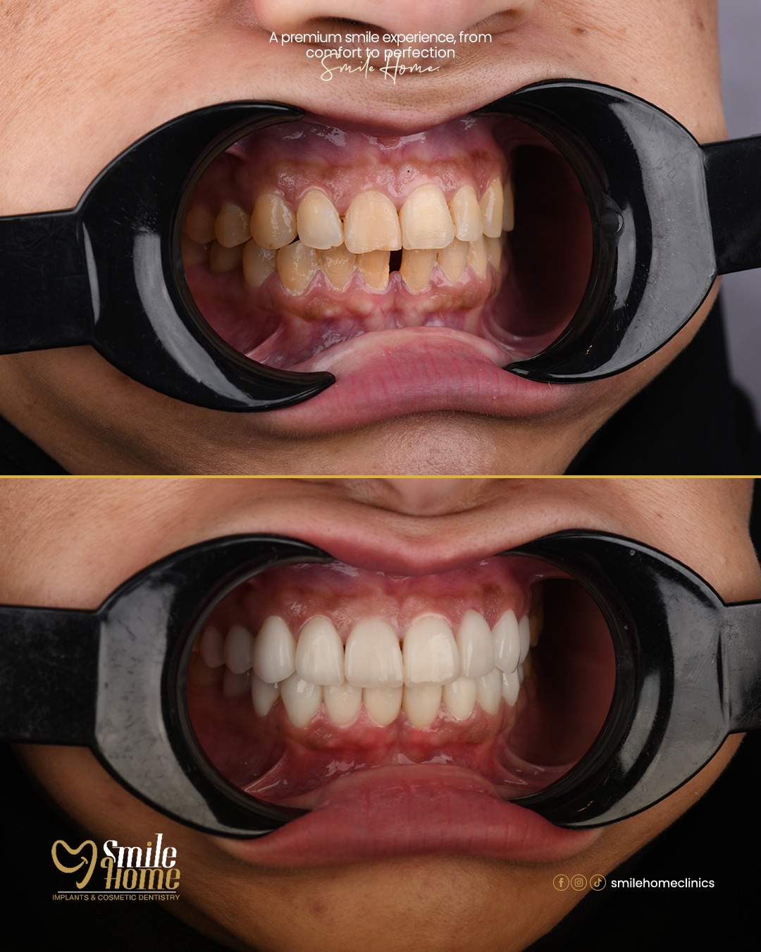Fixed prosthesis