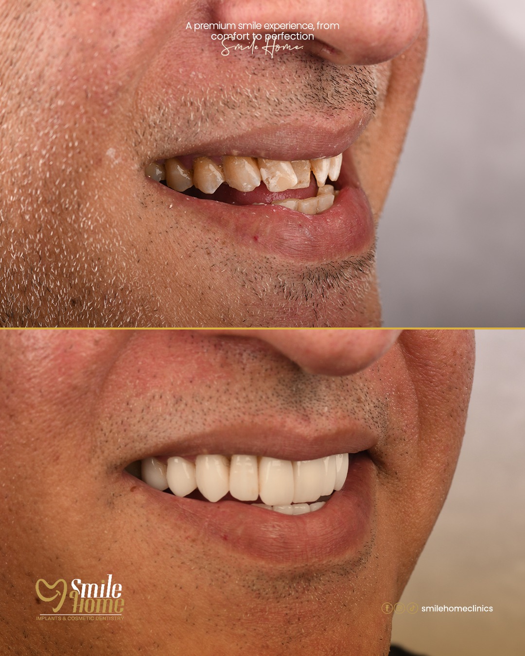 Fixed prosthesis