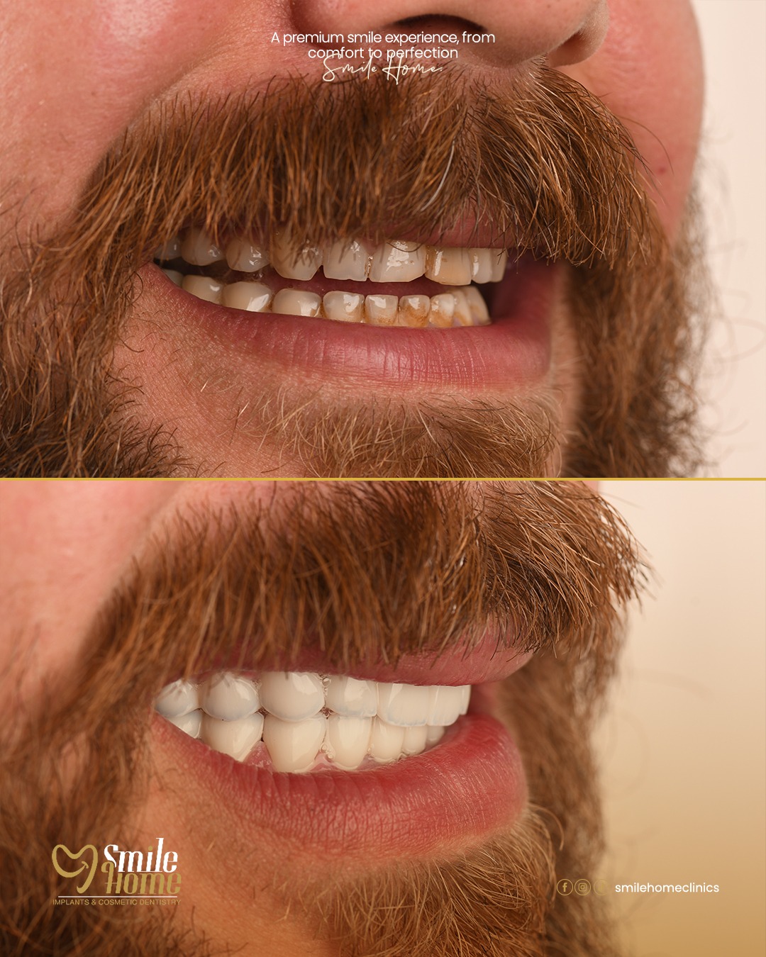 Fixed prosthesis