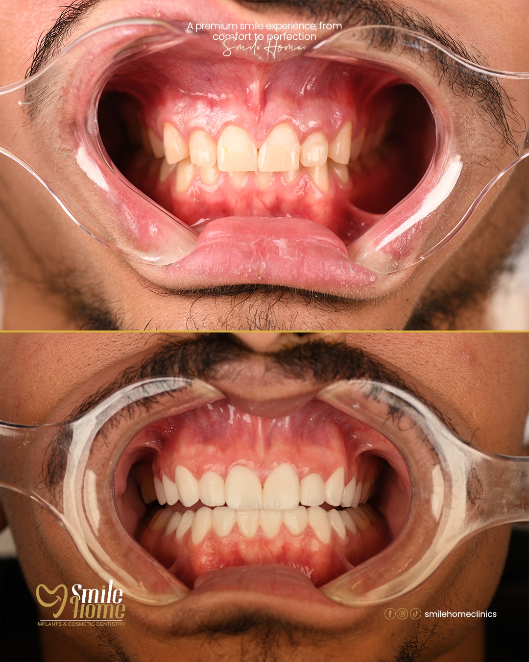 Fixed prosthesis