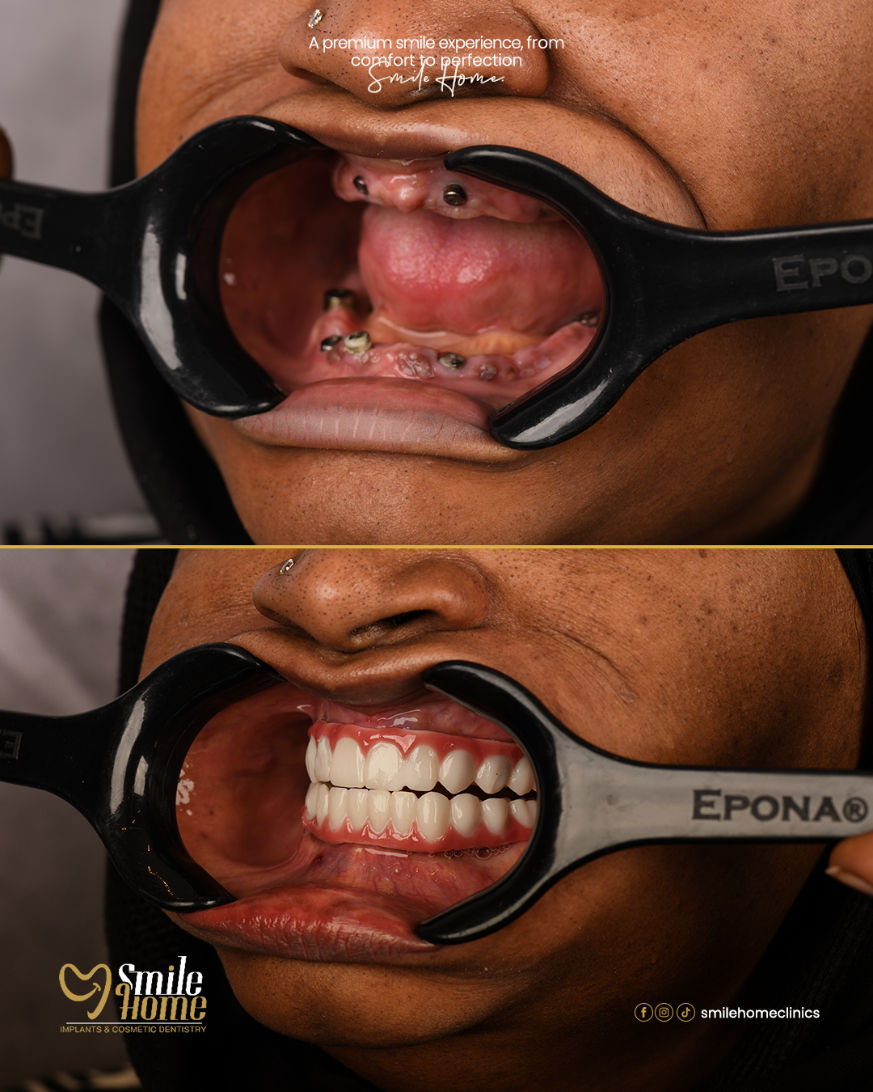 Implants