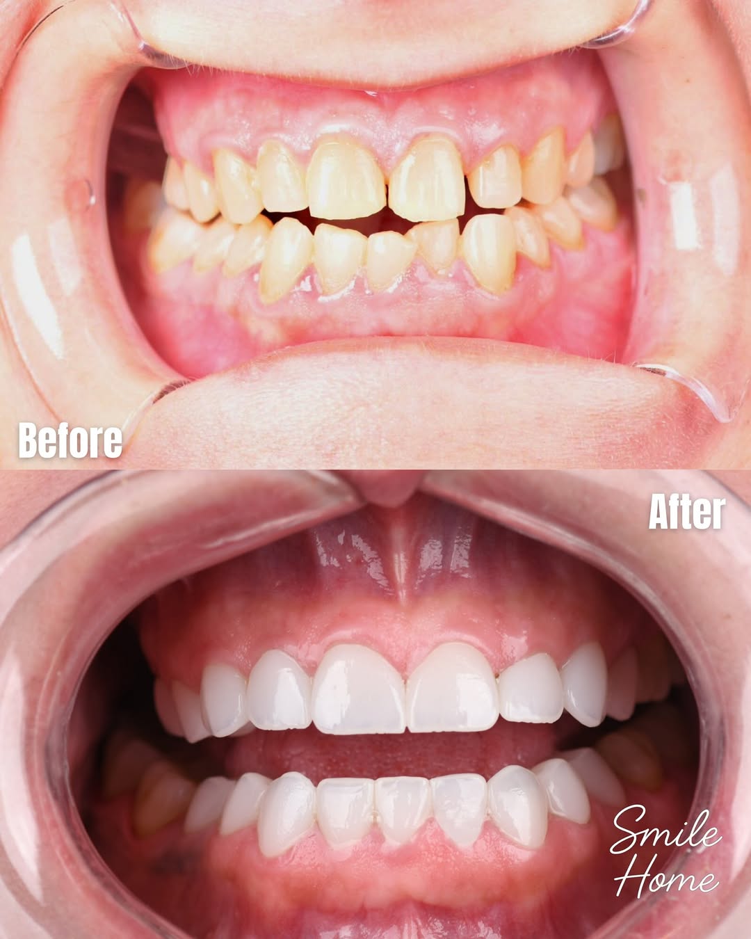 Full arch implant